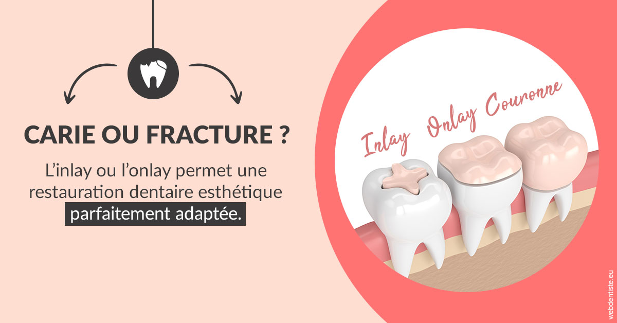 https://www.centremedicodentairecannes.com/T2 2023 - Carie ou fracture 2