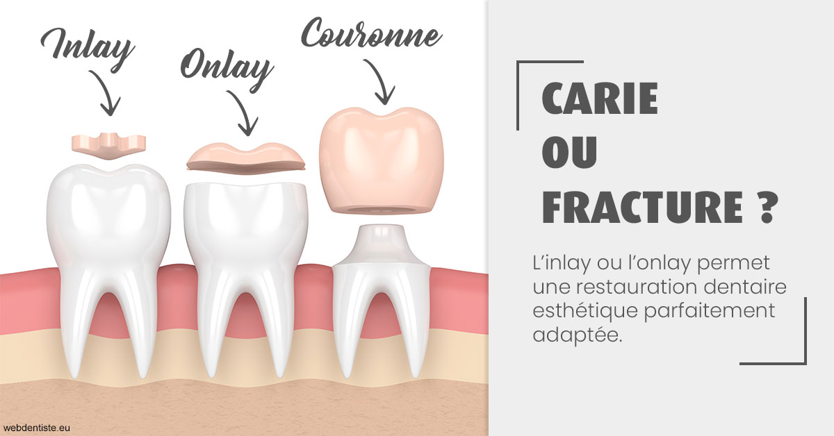 https://www.centremedicodentairecannes.com/T2 2023 - Carie ou fracture 1